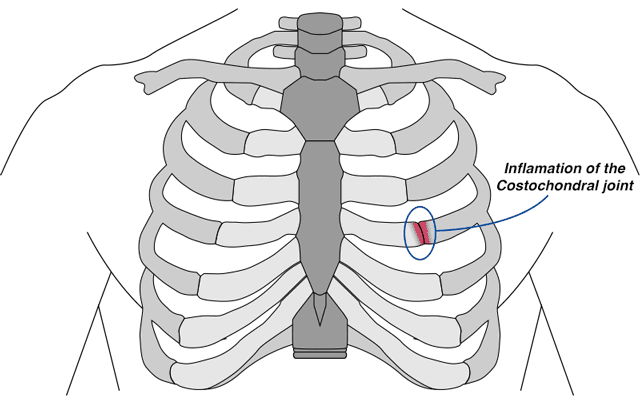 diagram of inflamation of the costochondral joint